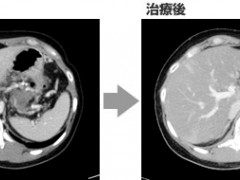 晚期胰腺癌女强人重回职场，因为体内多了这种的免疫细胞