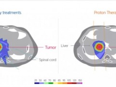 肝癌放疗选择精准放疗的质子放疗,精准打击肝癌细胞