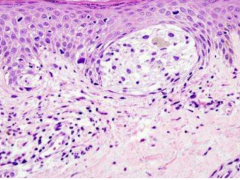 膀胱癌——PD-L1表达可预测免疫治疗疗效