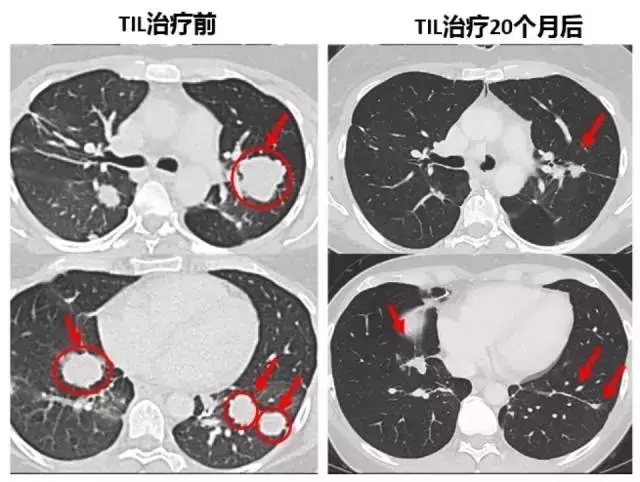 TIL治疗前后对比