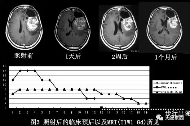 BNCT真实案例