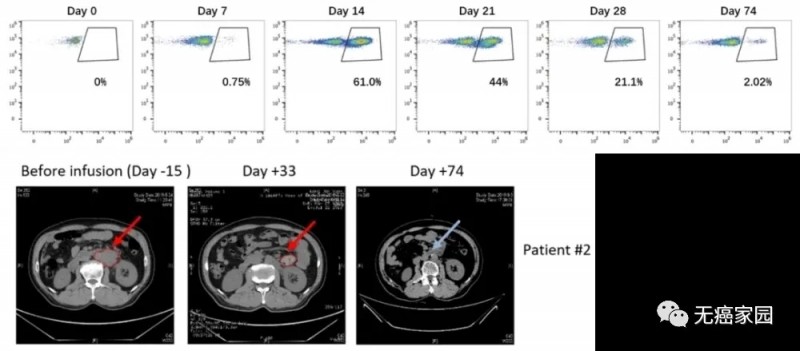 新型CAR-T在患者2体内的扩增和抗肿瘤能力
