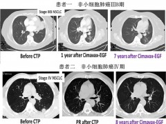 古巴肺癌疫苗帮助肺癌患者五年生存率从0提升至23%