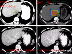 肝癌放疗,肝癌放疗技术有哪些,肝癌放疗的效果怎么样,肝癌放疗能活多久