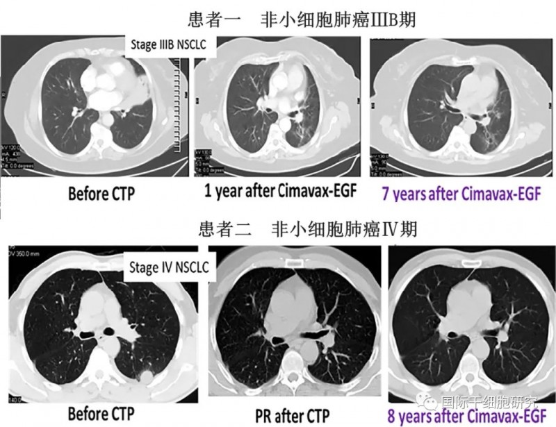 CIMAvax-EGF疫苗治疗效果