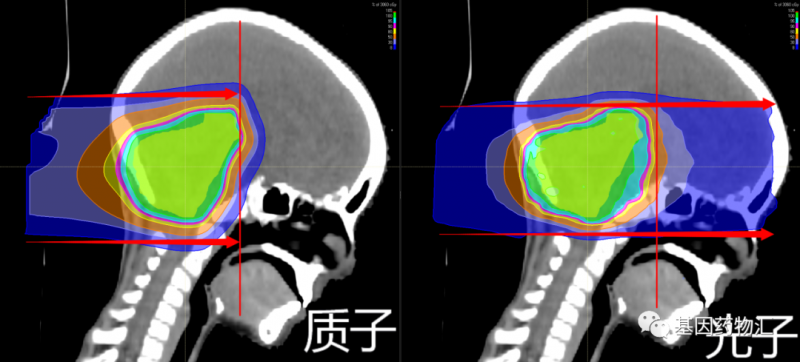 质子治疗肺癌脑转移