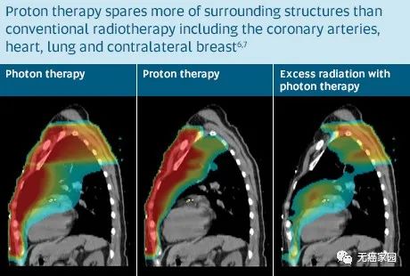 乳腺癌质子治疗和光子放疗