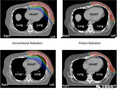 传统放疗和质子治疗乳腺癌放射范围对比