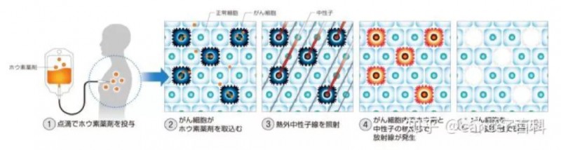 硼中子俘获治疗流程