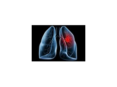 国际肺腺癌新分类和个体化肺癌外科思考