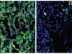 研究发现防止胰腺癌术后癌细胞转移的方法