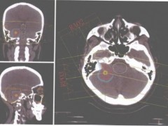 听神经瘤用质子刀做好吗,质子治疗听神经瘤病例参考