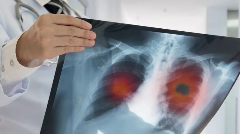 肺癌CT影像图