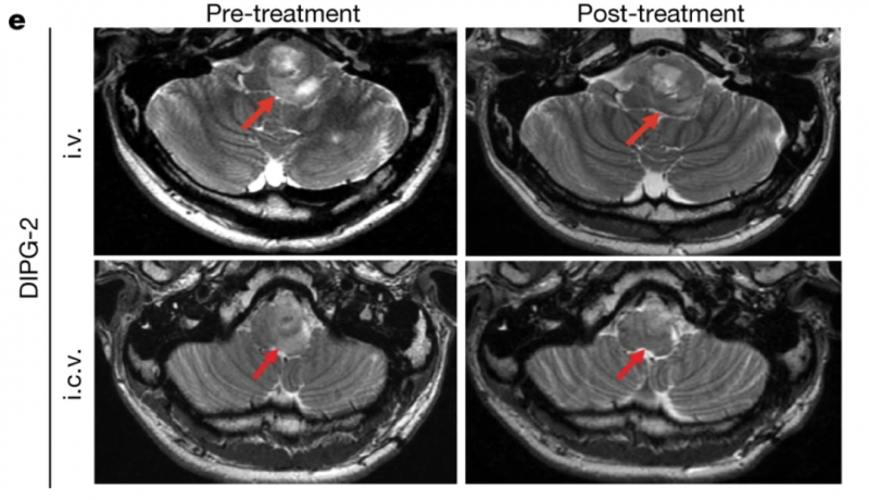 iv GD2-CAR-T治疗脑胶质瘤一个月后的效果