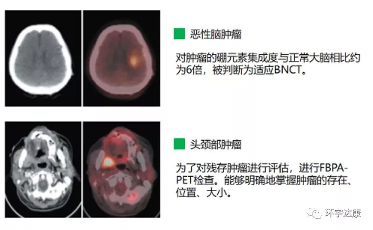 硼中子治疗脑瘤和头颈部肿瘤的效果