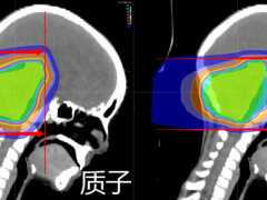 脑瘤质子治疗,儿科无小事!非常致命的脑瘤,用这种方案治疗,对孩子伤害更少