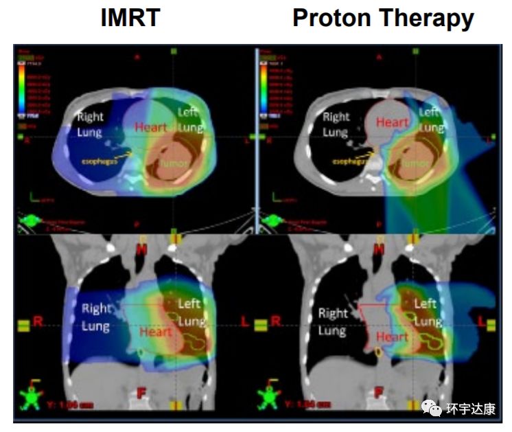 肺癌质子治疗和调强放疗对比