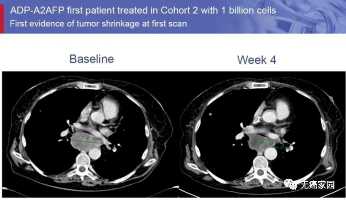 TCR-T疗法治疗肝癌纵膈淋巴结转移灶前后对比