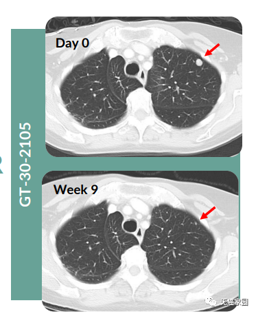 GNOS-PV02疫苗治疗肝癌和肺癌双原发病灶的效果