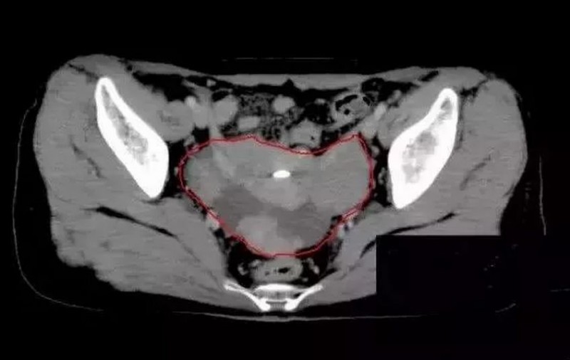 卵巢癌质子治疗前CT影像图