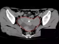 卵巢癌质子治疗成功案例