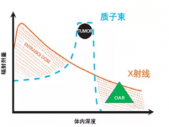 食道癌质子治疗的优势