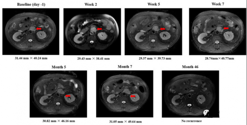 GPC3 CART疗法治疗晚期肝癌的效果