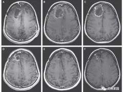 达拉非尼联合曲美替尼治疗BRAF V600E突变的胶质母细胞瘤肿瘤缩小50%,反应率高达33%,胶质母细胞瘤新疗法、新技术、新进展还有哪些
