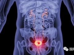 3种常见膀胱癌的治疗方法和6种FDA批准的膀胱癌免疫治疗方案