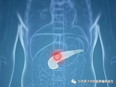 质子治疗胰腺癌成功案例分享