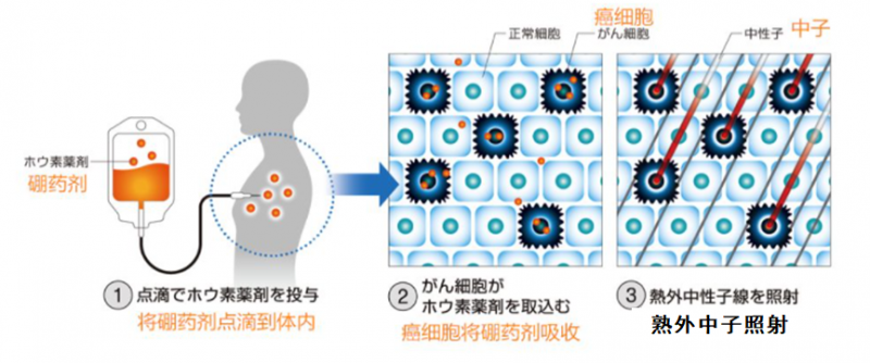 硼中子俘获治疗过程