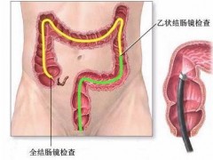 三步搞定结肠直肠癌