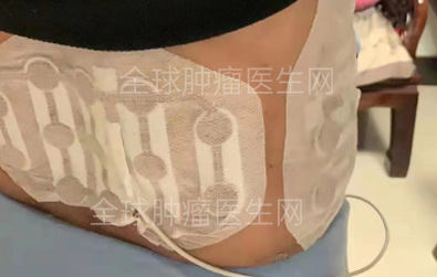 电场疗法